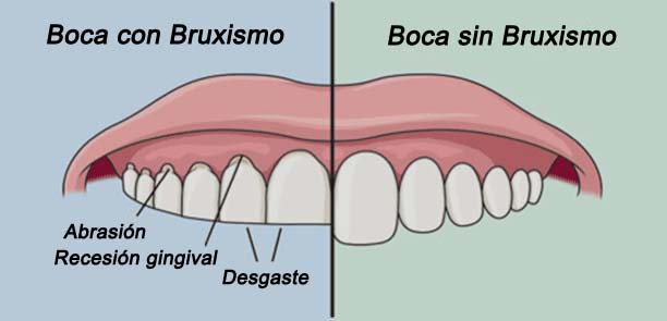 bruxismo