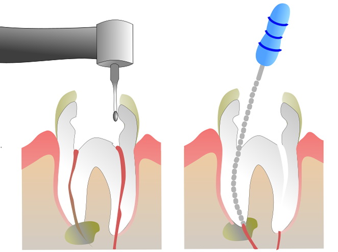 endodoncia